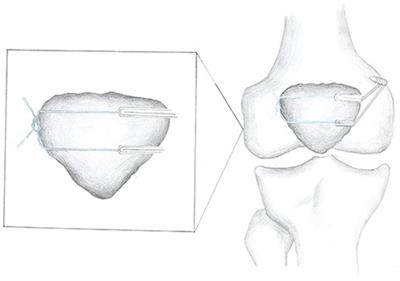 Active exercise therapy improves the recovery of knee joint function and reduction of muscle atrophy after medial patellofemoral ligament reconstruction for recurrent patellar dislocation